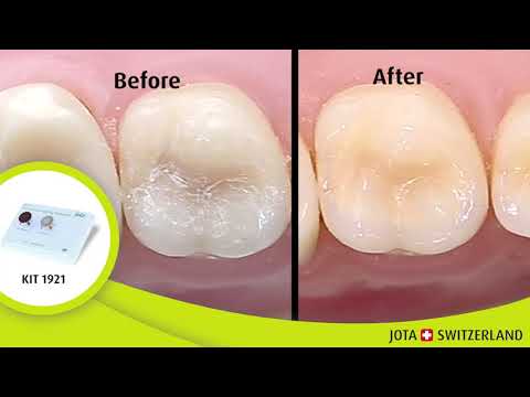 JOTA Extended Polishing Composite Kit RA 1939